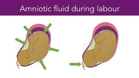 small leak of amniotic fluid|Amniotic Fluid: What is It and Signs of。